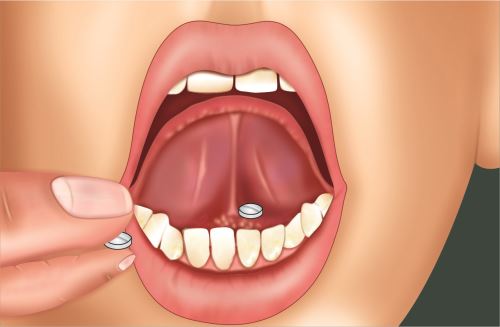 Buprenorphine Sublingual Tablets Explained